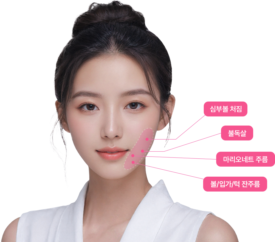 심부볼 처짐, 불독살, 마리오네트 주름, 볼/입가/턱 잔주름를 표시한 모델 사진