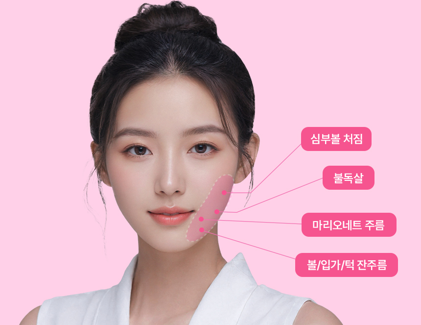 심부볼 처짐, 불독살, 마리오네트 주름, 볼/입가/턱 잔주름를 표시한 모델 사진