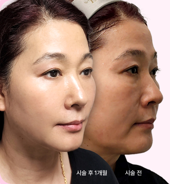 시술 후 1개월 / 시술전 사진