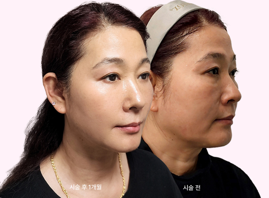 시술 후 1개월 / 시술전 사진