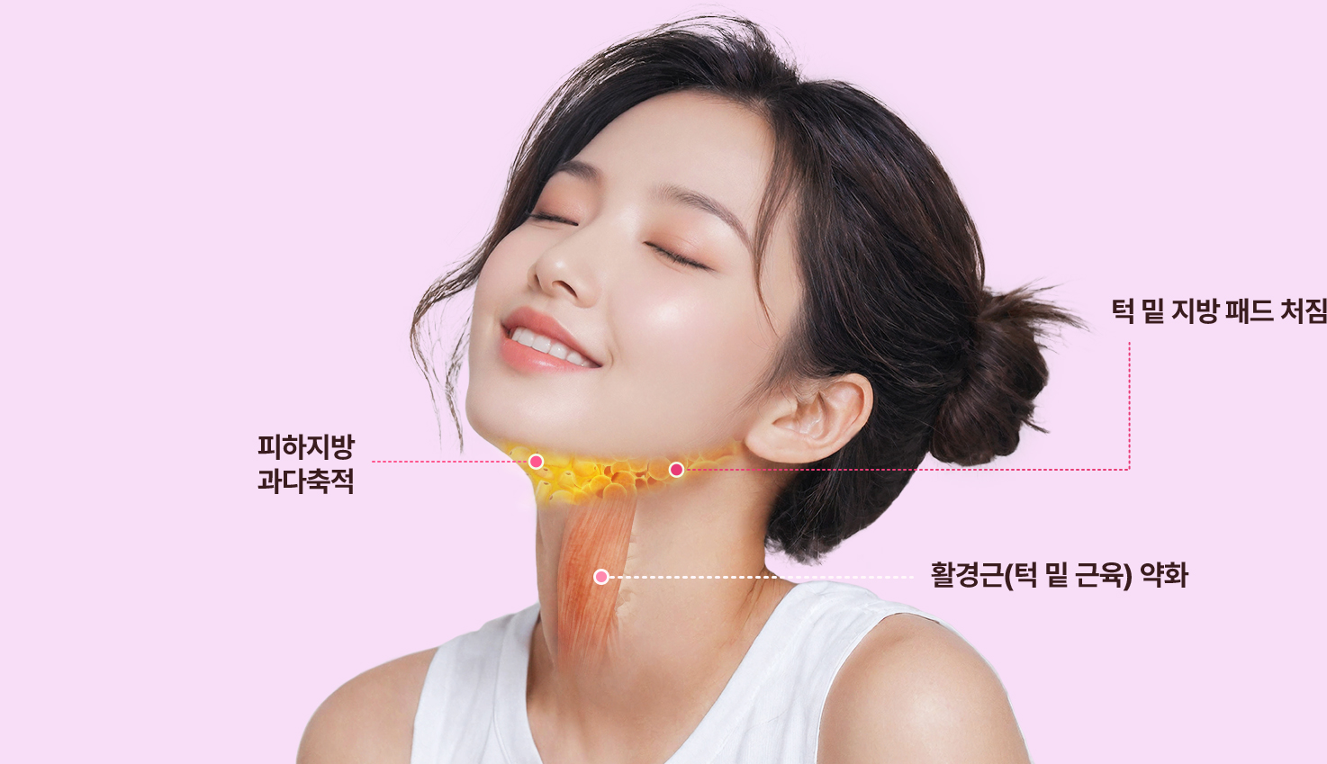 피하지방 과다축적, 턱 밑 지방 패드 처짐, 활경근(턱 밑 근육) 약화를 나타내는 사진