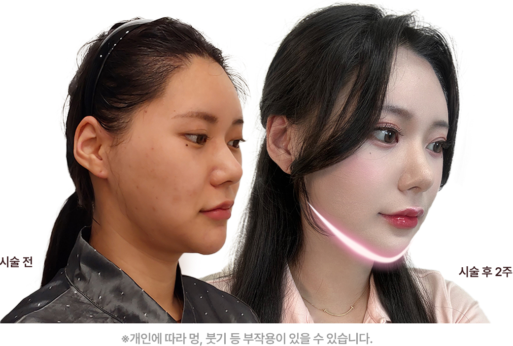 시술전 / 시술 후 2주 사진, *개인에 따라 멍, 붓기 등 부작용이 있을 수 있습니다.