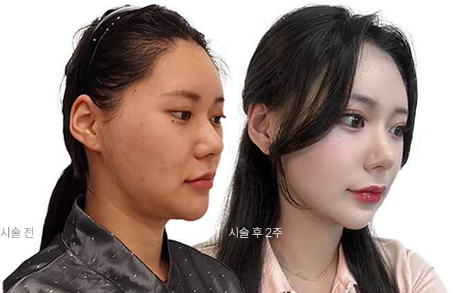 시술전 / 시술 후 2주 사진
