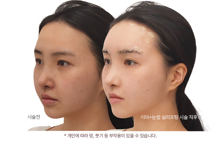 시술전 / 시술 후 1개월 사진,* 개인에 따라 멍, 붓기 등 부작용이 있을 수 있습니다.