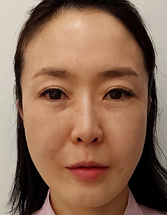 시술전 사진