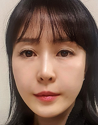 극진리프팅 시술 후 사진