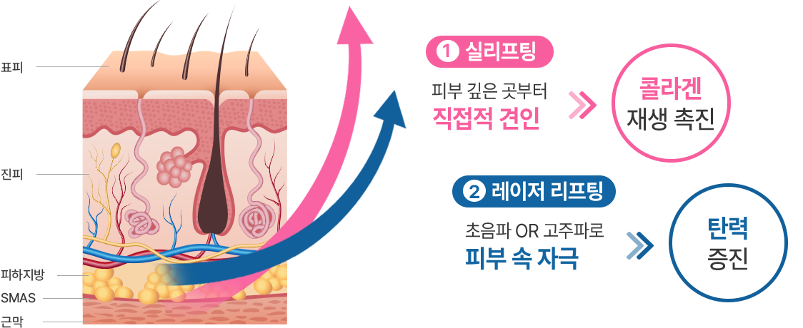 1.실리프팅: 피부 깊은 곳부터 직접적 견인 >> 콜라겐 재생 초직, 2.레이저 리프팅: 초음파 OR 고주파로 피부 속 자극 >> 탄력 증진