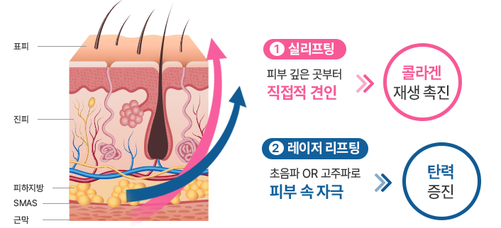 1.실리프팅: 피부 깊은 곳부터 직접적 견인 >> 콜라겐 재생 초직, 2.레이저 리프팅: 초음파 OR 고주파로 피부 속 자극 >> 탄력 증진