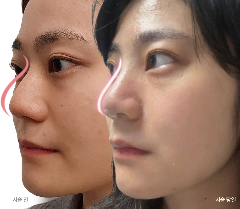 시술전/시술당일 모델사진