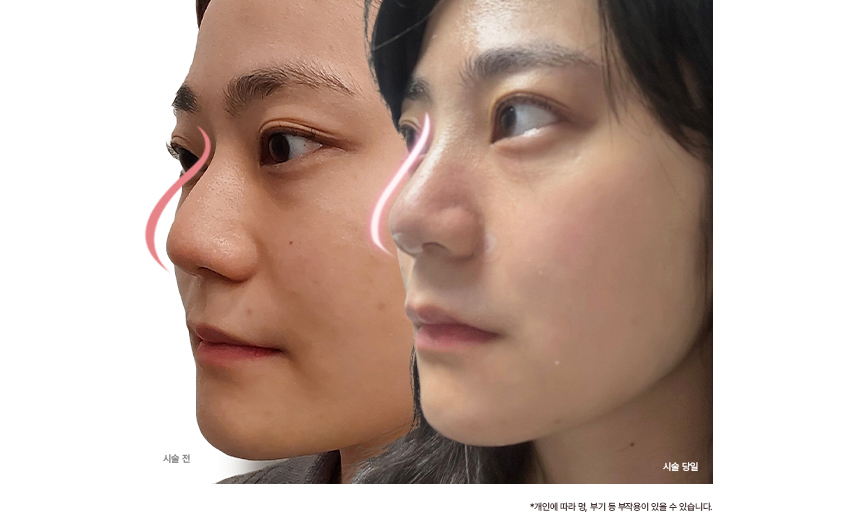 시술전/시술당일 모델사진
