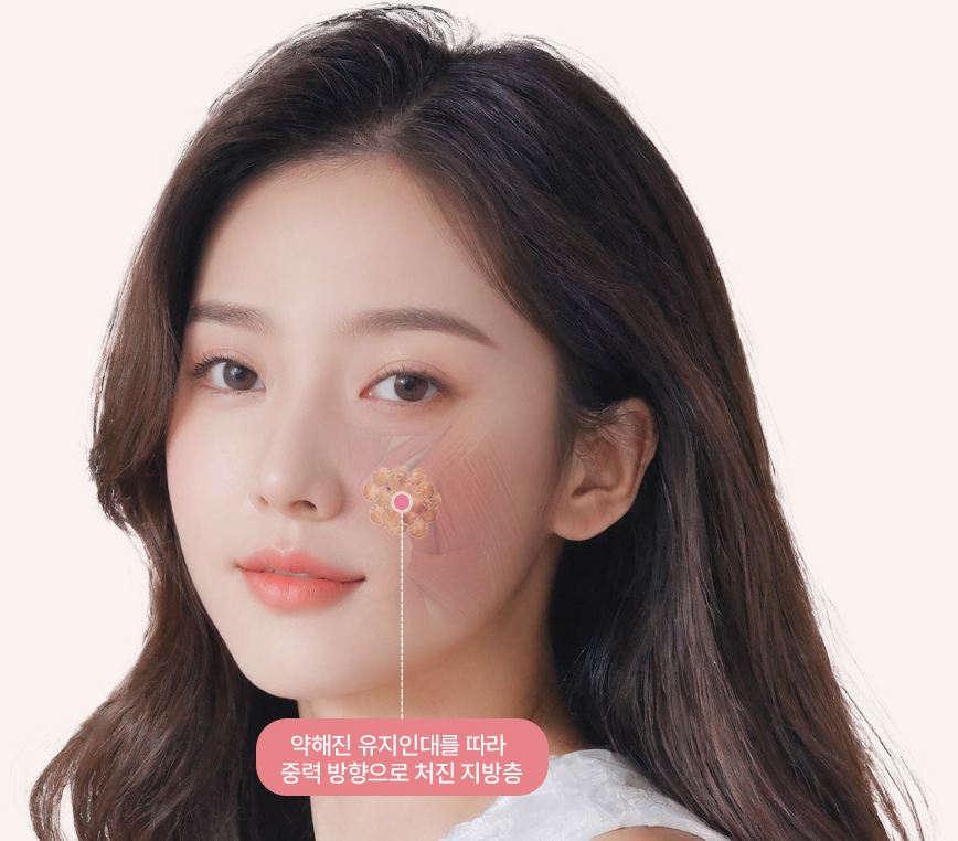 약해진 유지인대를 따라 중력 방향으로 처진 지방층