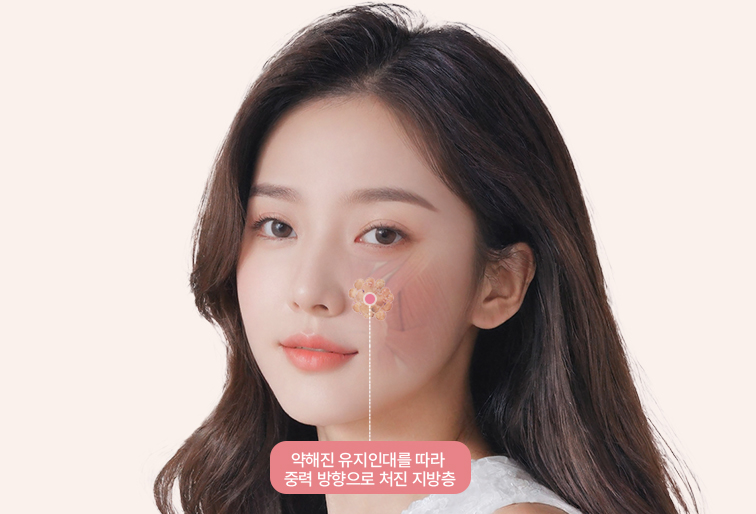 약해진 유지인대를 따라 중력 방향으로 처진 지방층
