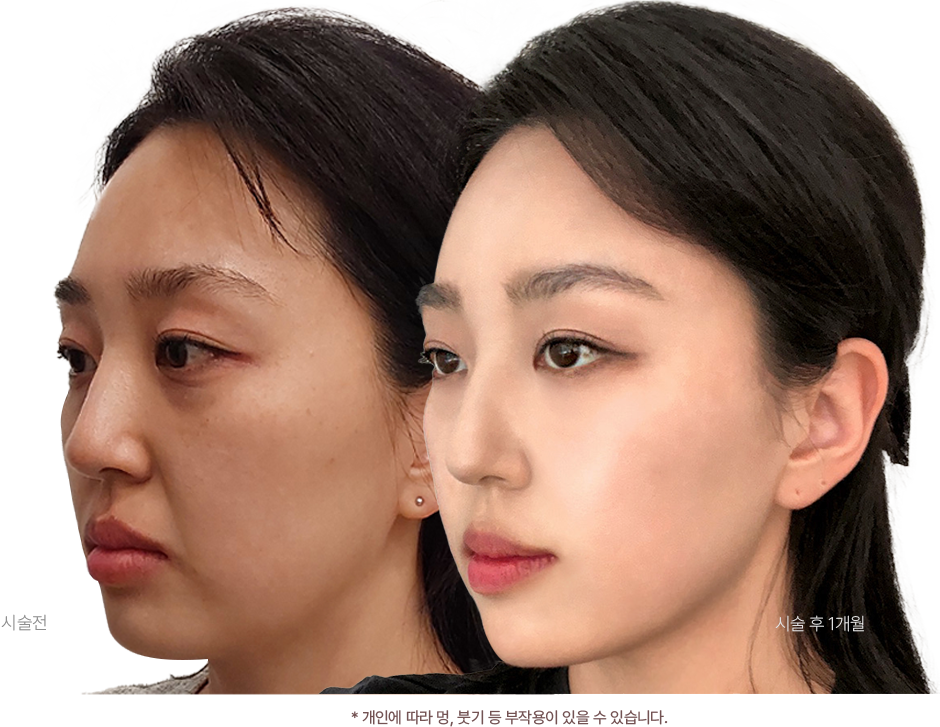 시술전 / 시술 후 1개월 사진, *개인에 따라 멍, 붓기 등 부작용이 있을 수 있습니다.