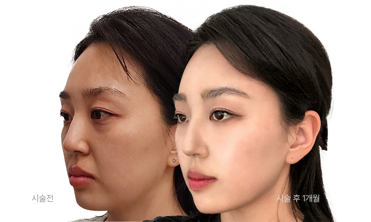 시술전 / 시술 후 1개월 사진